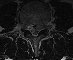 Sequestered Disc MRI 4